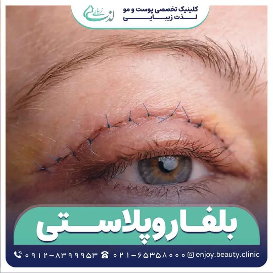 بلفاروپلاستی