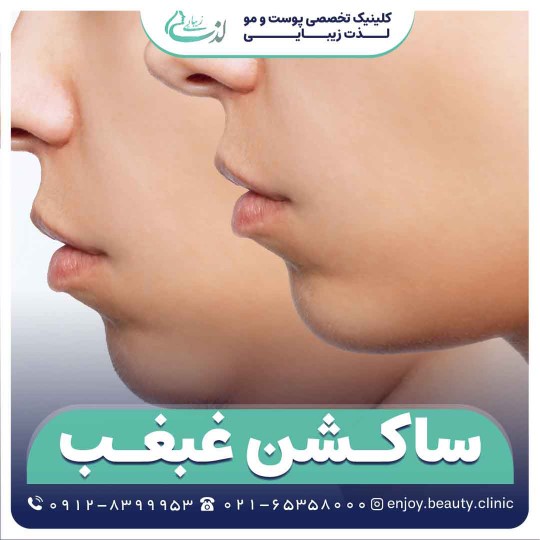 ساکشن غبغب