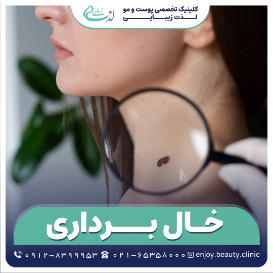 خال برداری