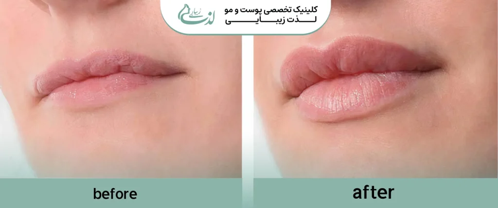 فیلر لب