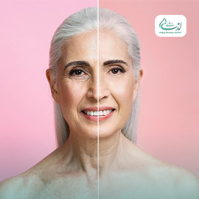 بوتاکس